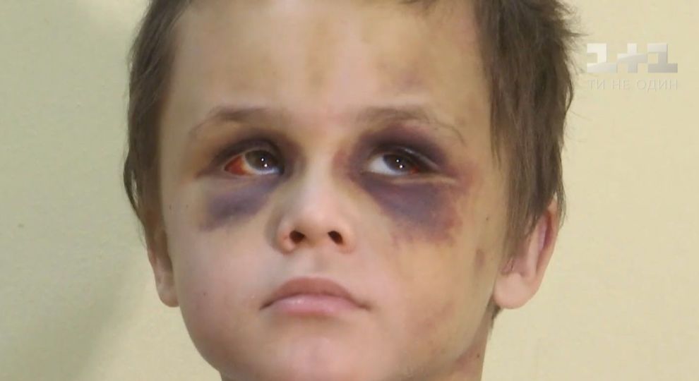 У побитті 6-річного хлопчика підозрюють співмешканку його батька