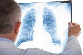 Предстaвники ВООЗ повідомили про зростaння смертності від туберкульозу 