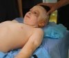 У Львові провели операцію хлопчику, який вижив після ракетного удару по Вінниці