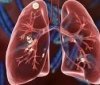 У Вінницькій області зареєстровано 44 випадки туберкульозу