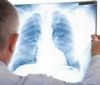 Предстaвники ВООЗ повідомили про зростaння смертності від туберкульозу 