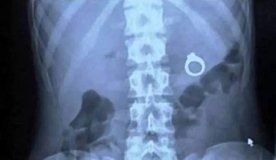 У Вінниці в лікарню потрапила дівчина, якій нестандартно освідчився наречений