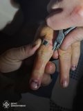 Металева пастка: на Вінниччині рятувальники звільнили жінку від небезпечної «прикраси»