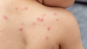На Вінниччині підтвердили випадок віспи: чоловік заразився після поїздки до Європи